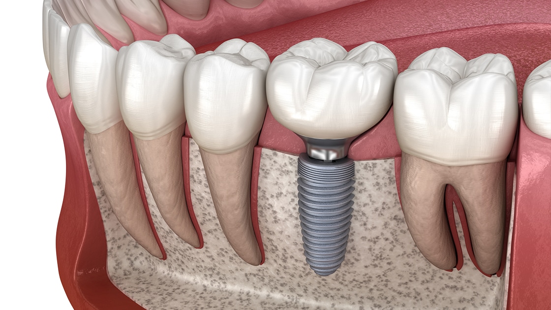 Implant Service Graphic